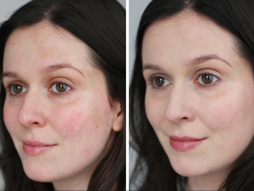 В домашних условиях после применения. Фарфоровая кожа до и после. Фарфоровая кожа лица до и после. Лицо до и после мезороллера. Мезороллером для лица до после.